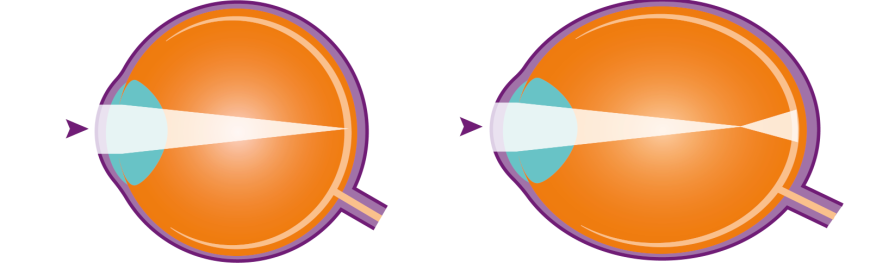 Myopia Myopia